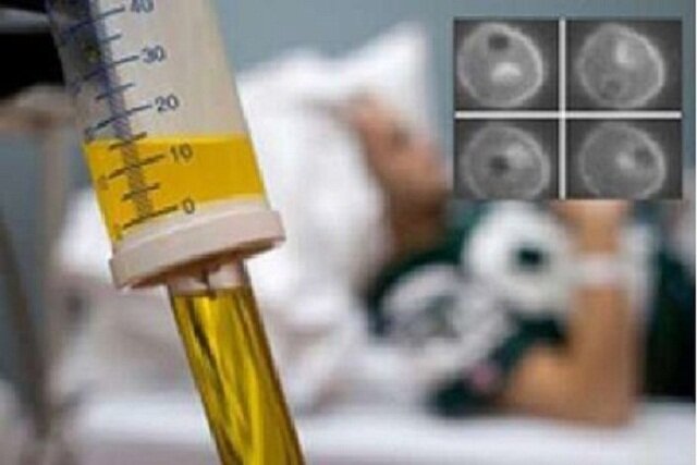 دستیابی به دانش فنی تولید داروی کاهش اوره در مبتلایان به سرطان