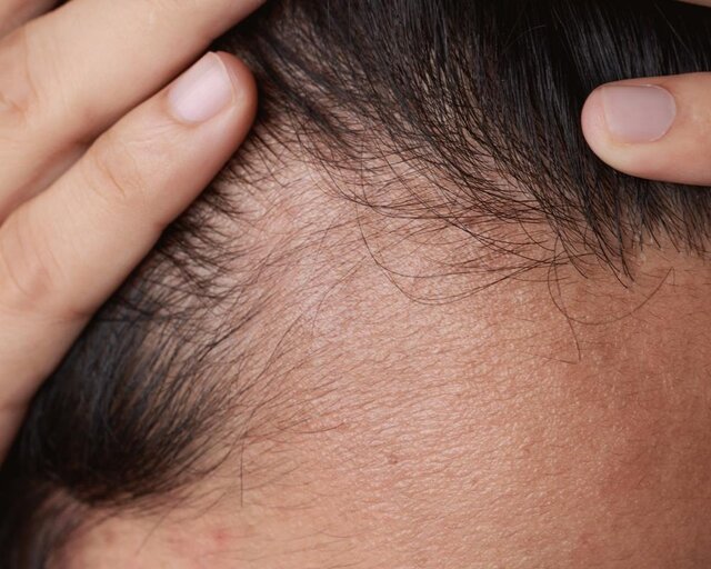 عادت‌های ساده برای جلوگیری از ریزش مو