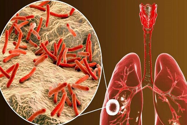 آشنایی با بیماری سل و پیشگیری از ابتلا به آن
